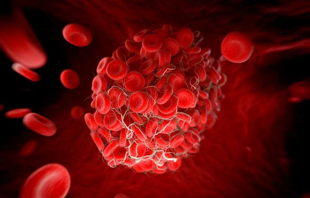 Women with 4 key risk factors at much greater risk of killer blood clots, scientists discover | The Sun